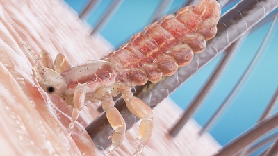 Vši u dětí a dospělých – ihned řešte! Vši u dětí a dospělých – ihned řešte!