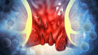 Co pomáhá na hemoroidy – úleva od bolesti a svědění