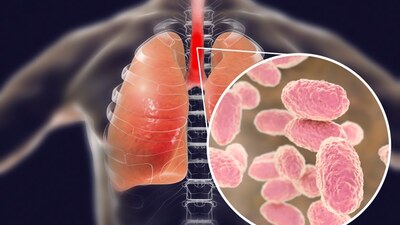 Černý kašel - projevy, prevence a léčba Černý kašel - projevy, prevence a léčba