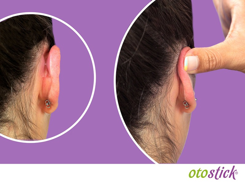 Otostick pro dospělé korektor odstávajících uší 8 ks