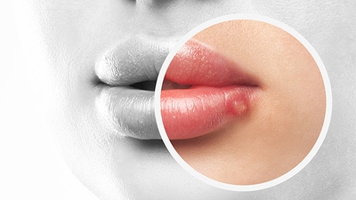 Opary a plané neštovice – banalita nebo celoživotní zátěž?