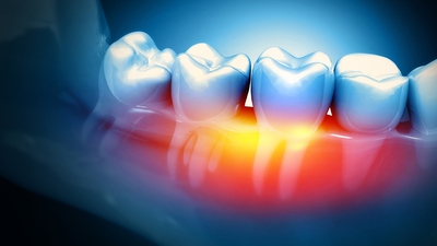 Paradentóza – jak předcházet krvácení dásní? Paradentóza – jak předcházet krvácení dásní?