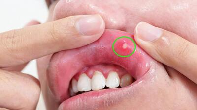 Proč se dělají afty a jak tomu zabránit?