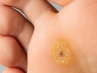 Bradavice na nohou, rukou a genitáliích – v čem se liší molusky?