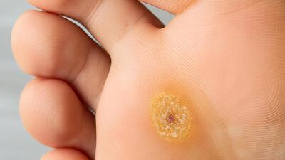 Bradavice na nohou, rukou a genitáliích – v čem se liší molusky?