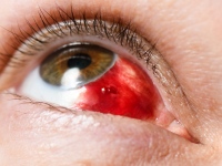 Červené zarudlé oči – co dělat při zánětu spojivek?