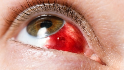 Červené zarudlé oči – co dělat při zánětu spojivek?