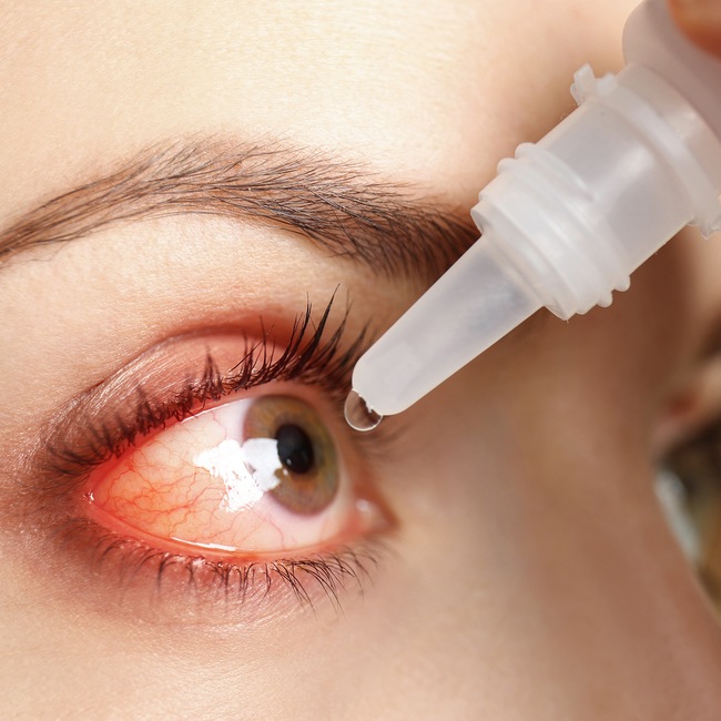 Oční kapky – jak pomoci zarudlým očím?