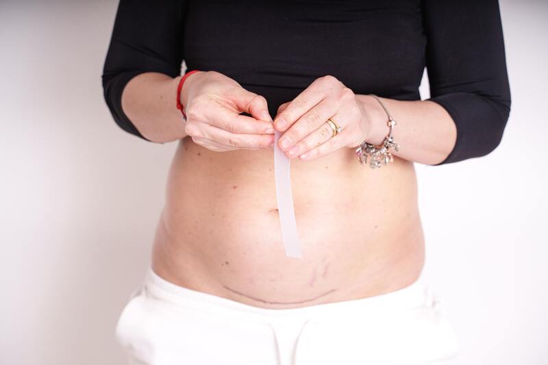 MomCare Silikonové náplasti po císařském řezu vel. L-XL 3 ks
