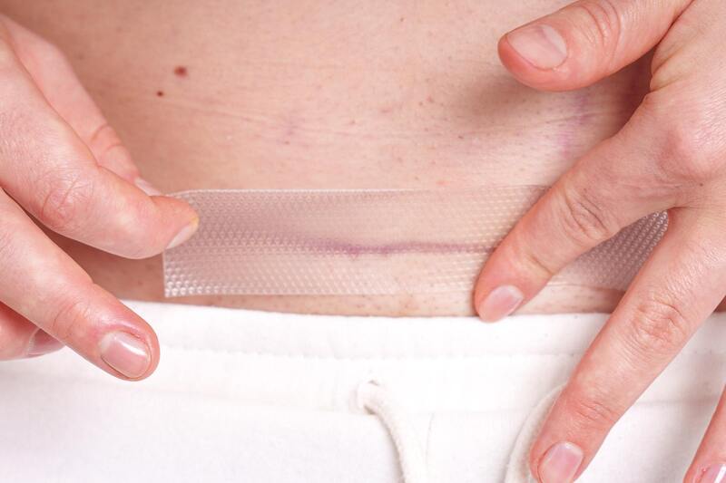 MomCare Silikonové náplasti po císařském řezu vel. L-XL 3 ks