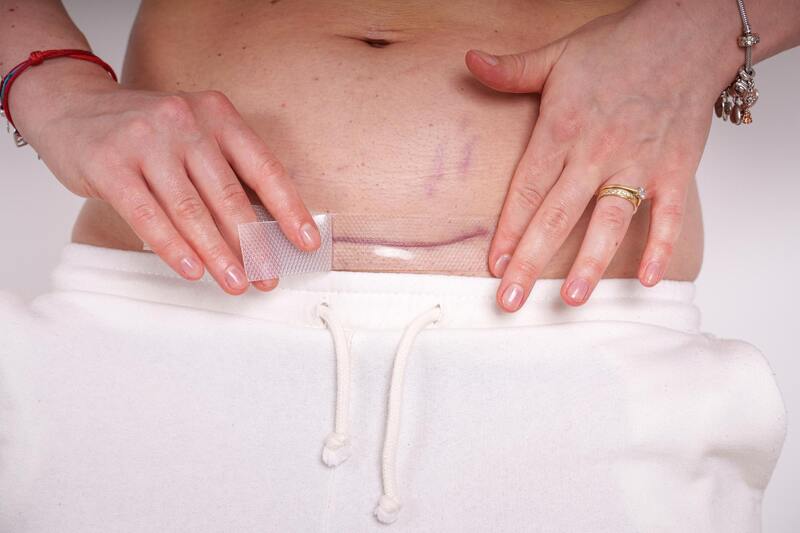 MomCare Silikonové náplasti po císařském řezu vel. S-M 3 ks